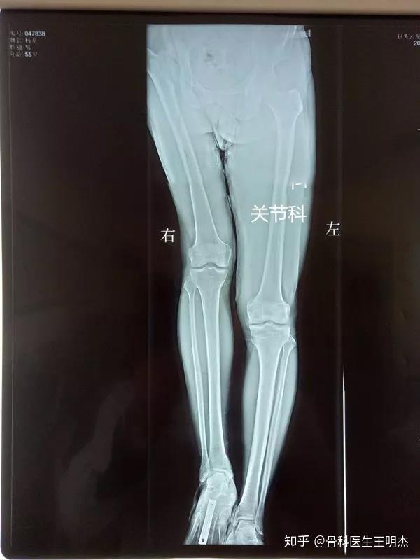 青少年的长短腿分为两种,一种叫做结构性的长短腿,即测量两腿的绝对