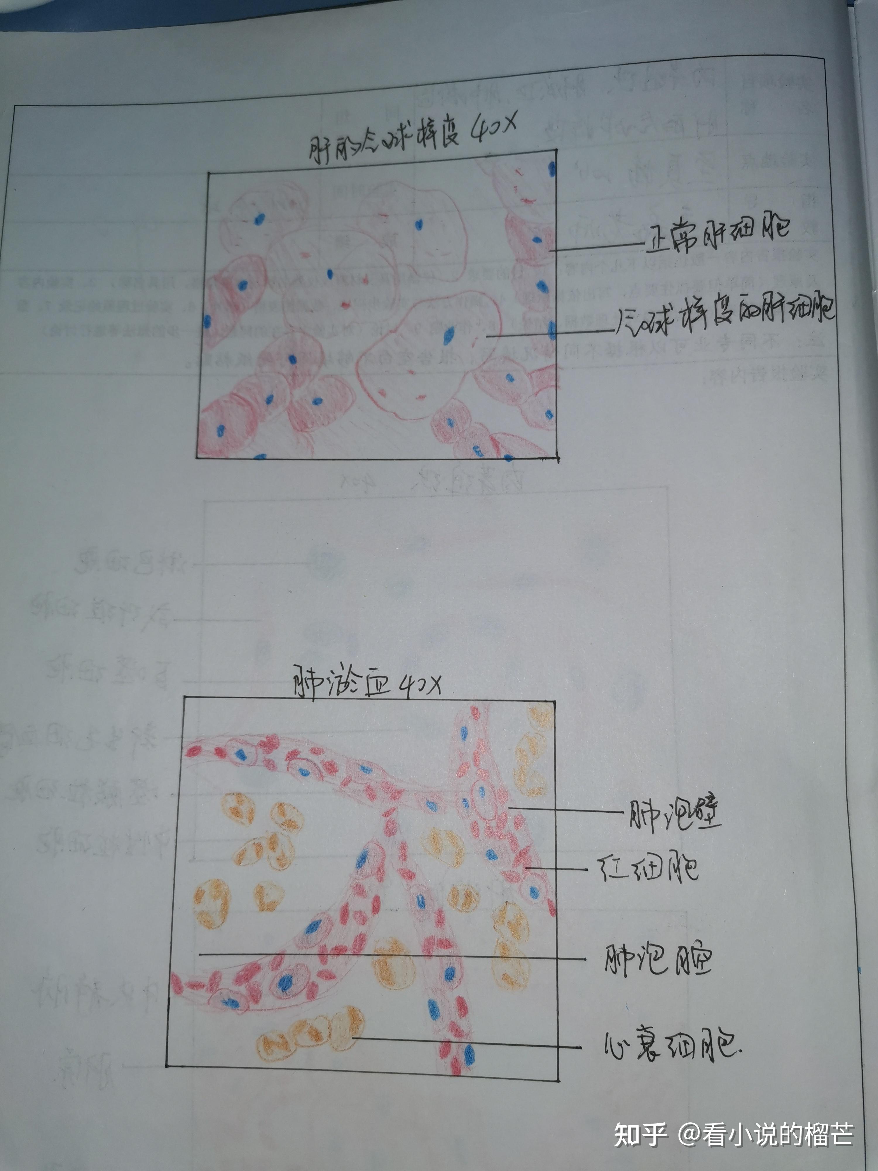 肺淤血图片红蓝铅笔图片