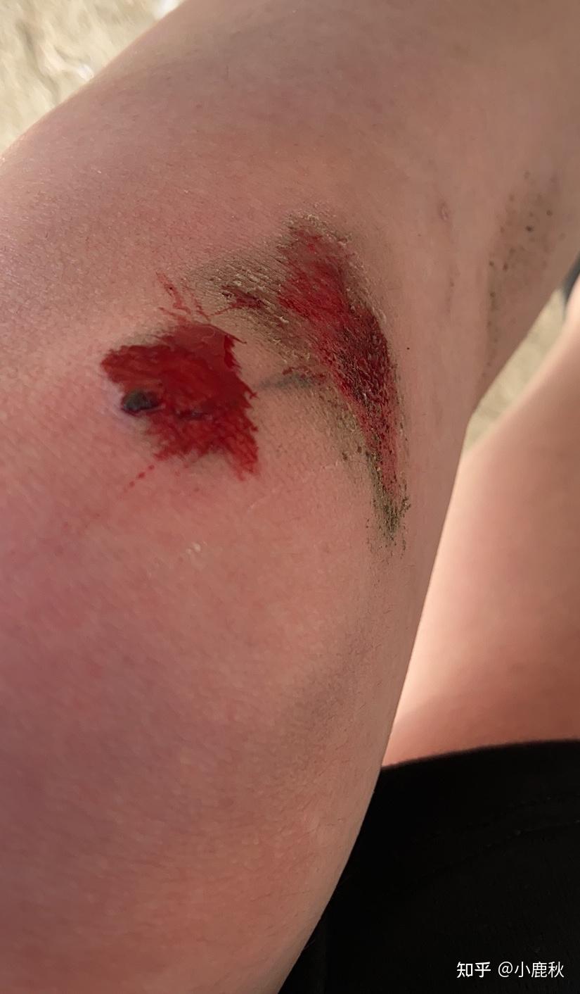 骑电动车摔跤受伤图片图片