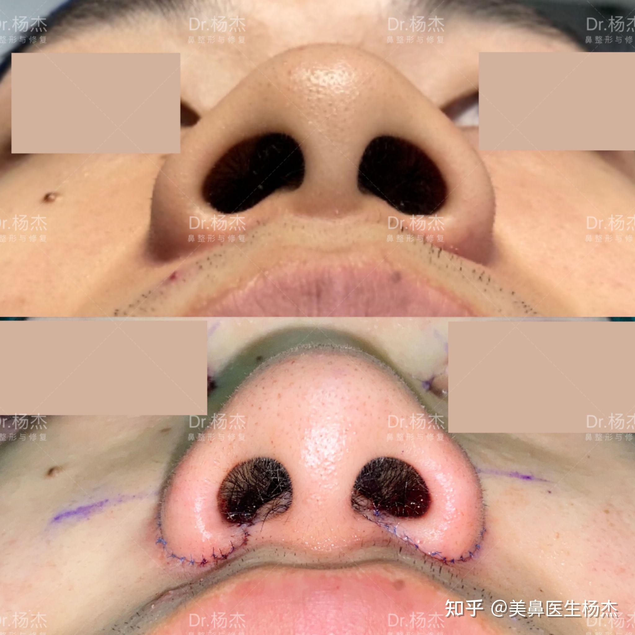鼻翼缩小效果怎么样? - 知乎