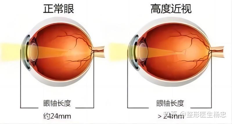 如何才能像赵金麦一样逆袭肿泡眼、凸眼球？ - 知乎