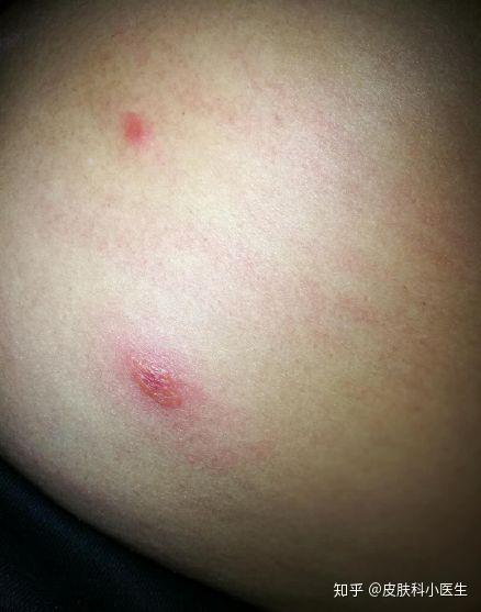 丘疹性荨麻疹虫咬皮炎案例分享