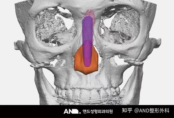 打造吴妍书鼻子般自然、高、细滑的鼻部线条[通过3D打印的艺人鼻部整形]:鼻部再手术（鼻梁整形+鼻尖整形+人中鼻+龙鼻+功能鼻+鼻翼缩小）前后 ...