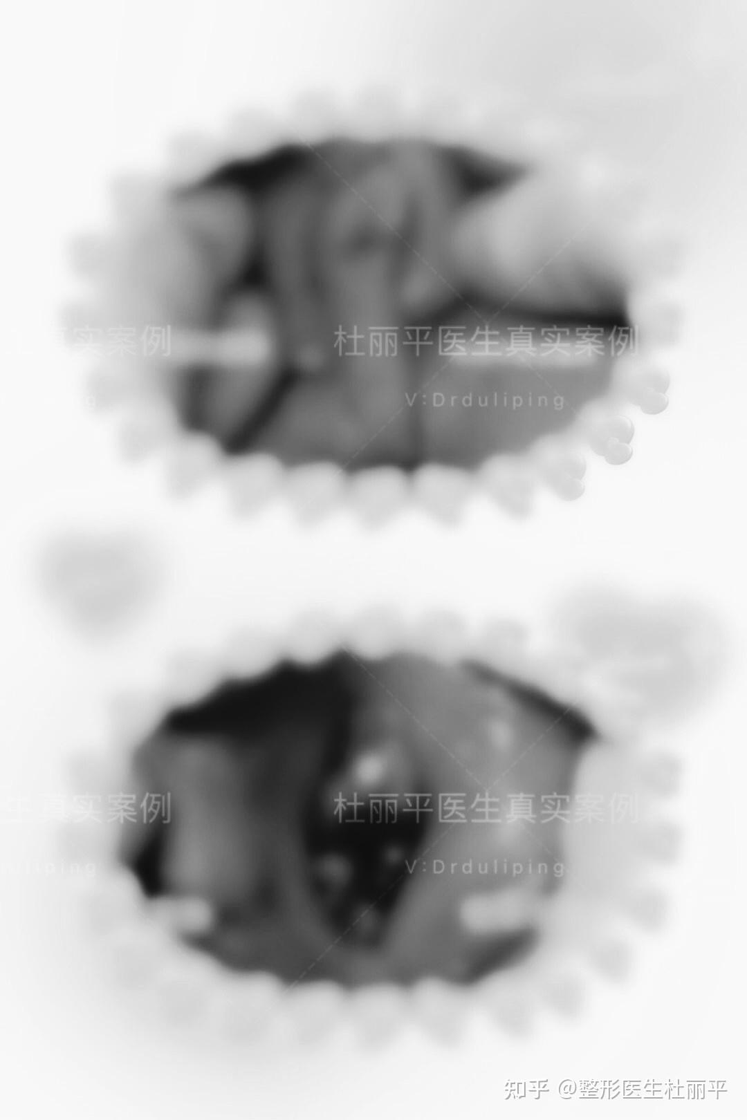 处女膜 