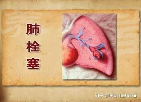 中医辩证法教你了解肺栓塞及症状 知乎