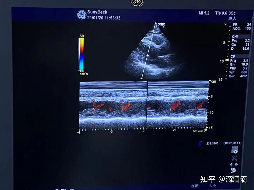 早产36周+4天，心脏B超结果为：主动脉肺动脉内径正常，房室不扩大，各心瓣膜回声纤细，室间隔与左室 - 百度宝宝知道