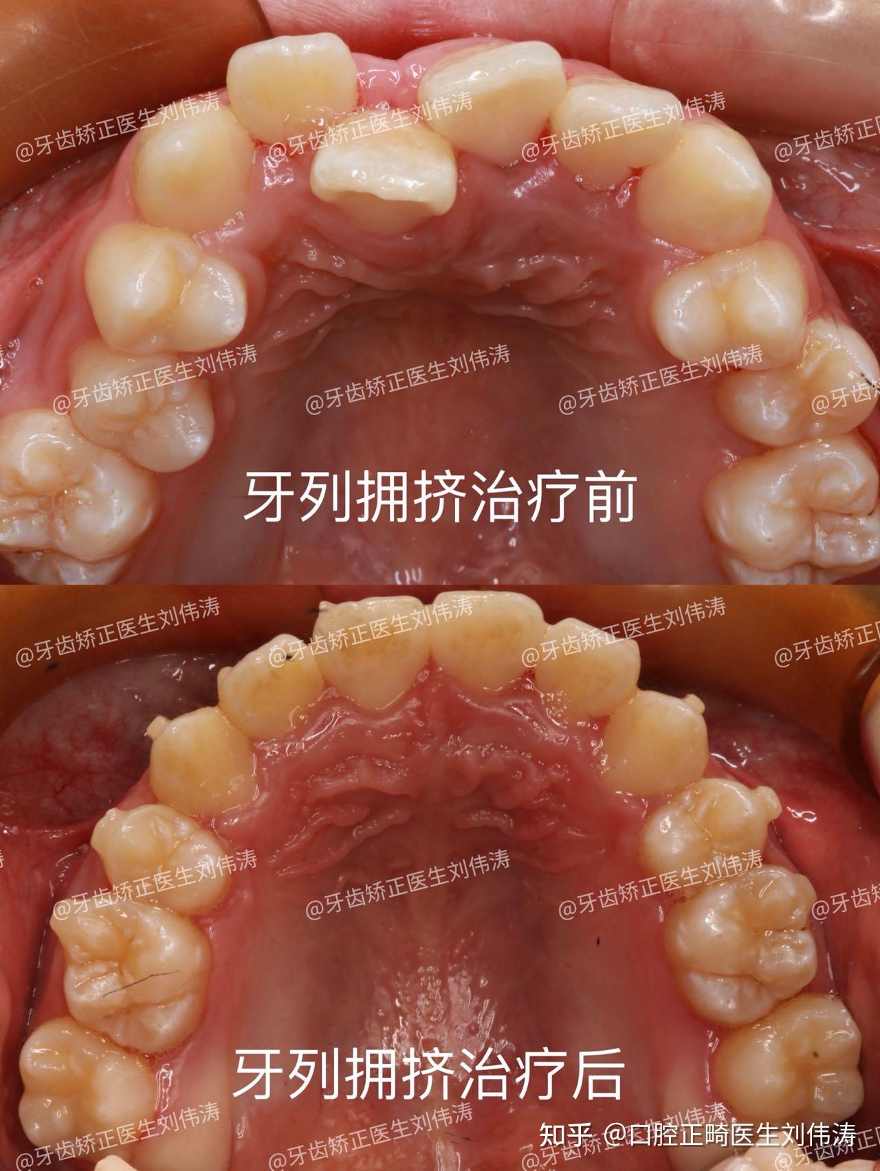 早期阻断性矫治(四)牙列拥挤的矫治 - 知乎