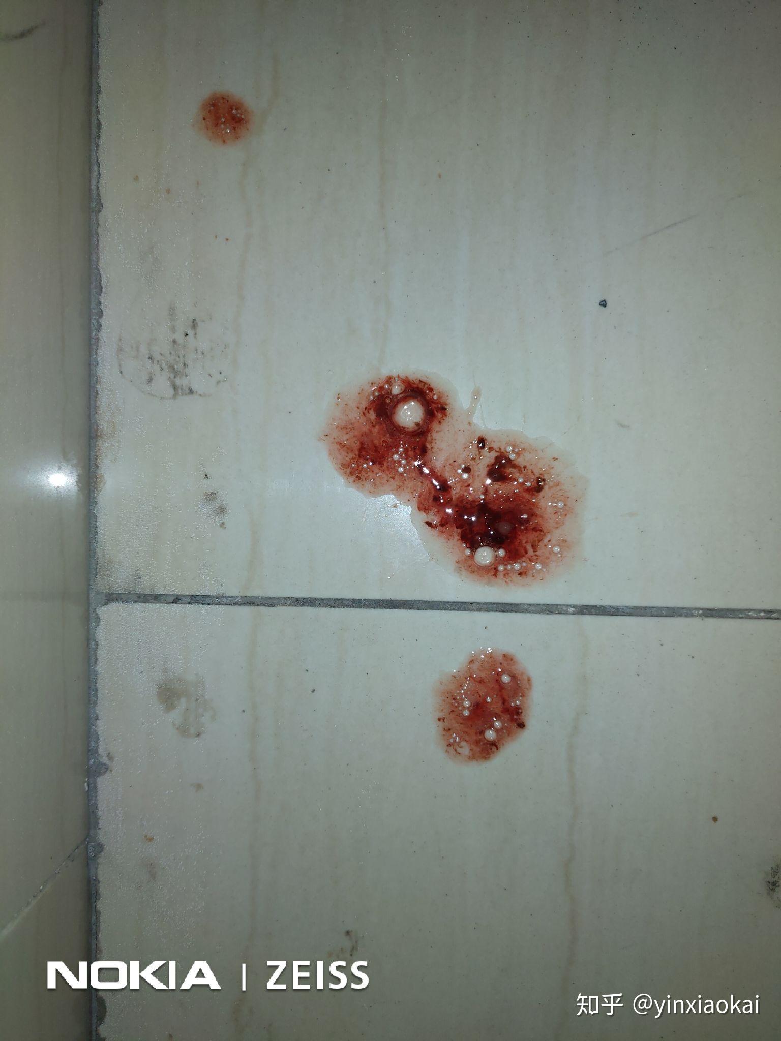 胃出血是一种什么样的体验