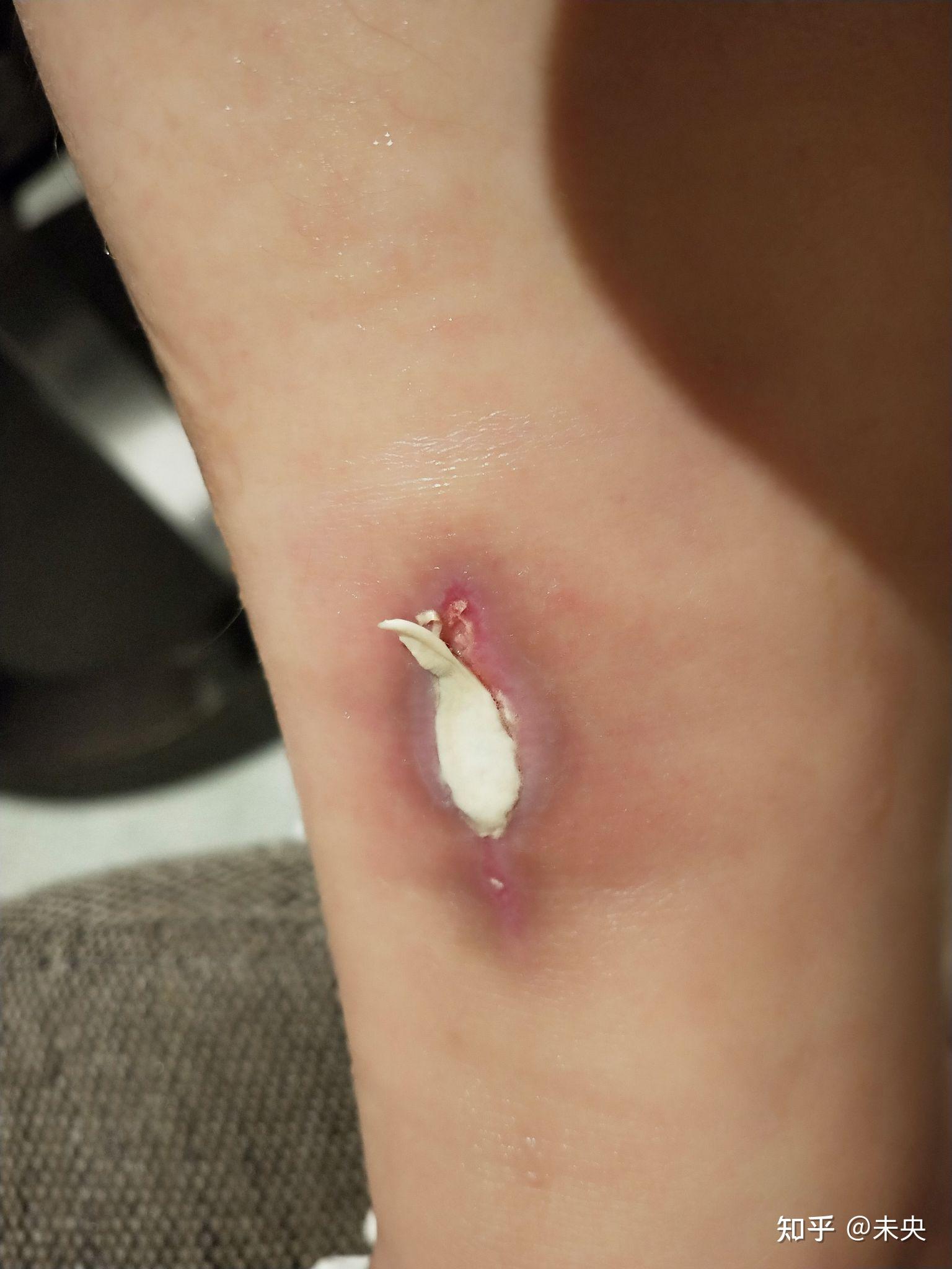 低温烫伤治疗全程分享