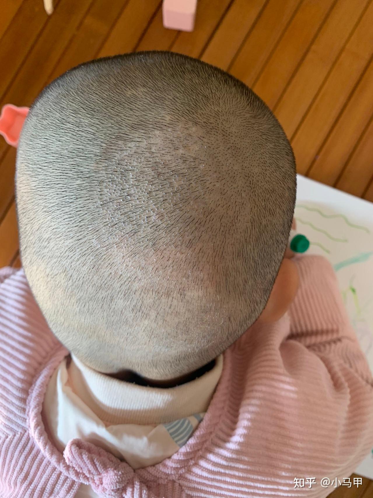 2岁女娃头癣(黑点癣)治疗过程