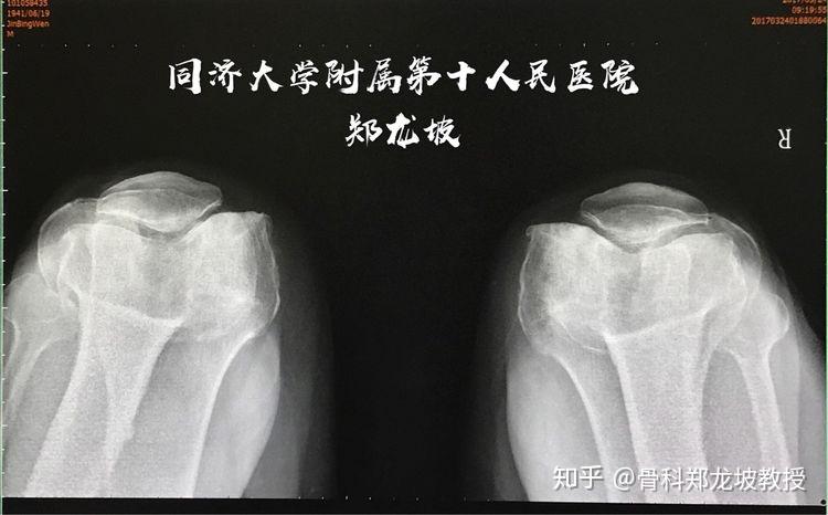 髌骨轴位片清晰显示髌股关节磨损状况