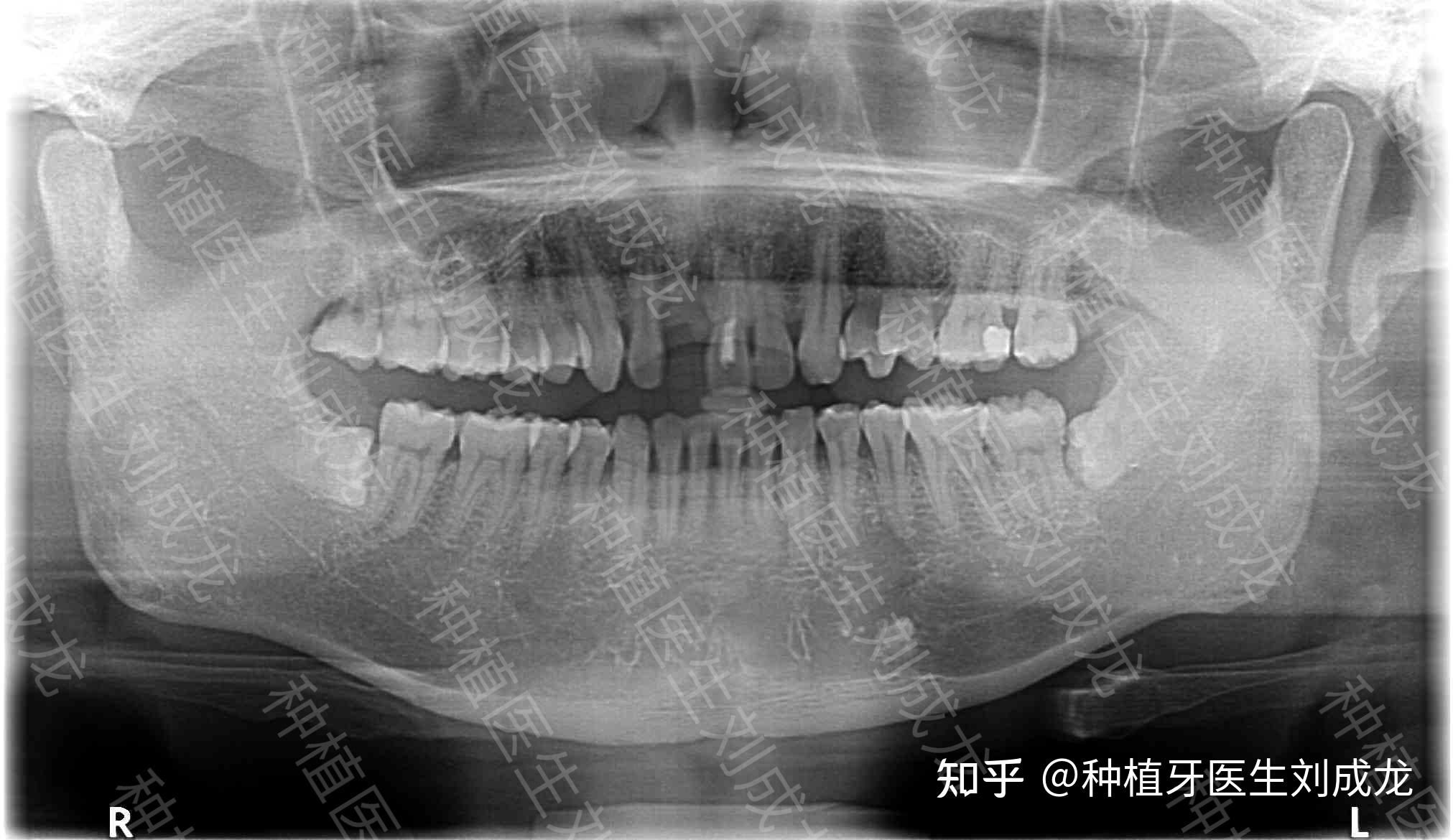 男患者訴求:11缺失,要求修復上前牙缺失現病史:11因牙髓炎於外院拔除