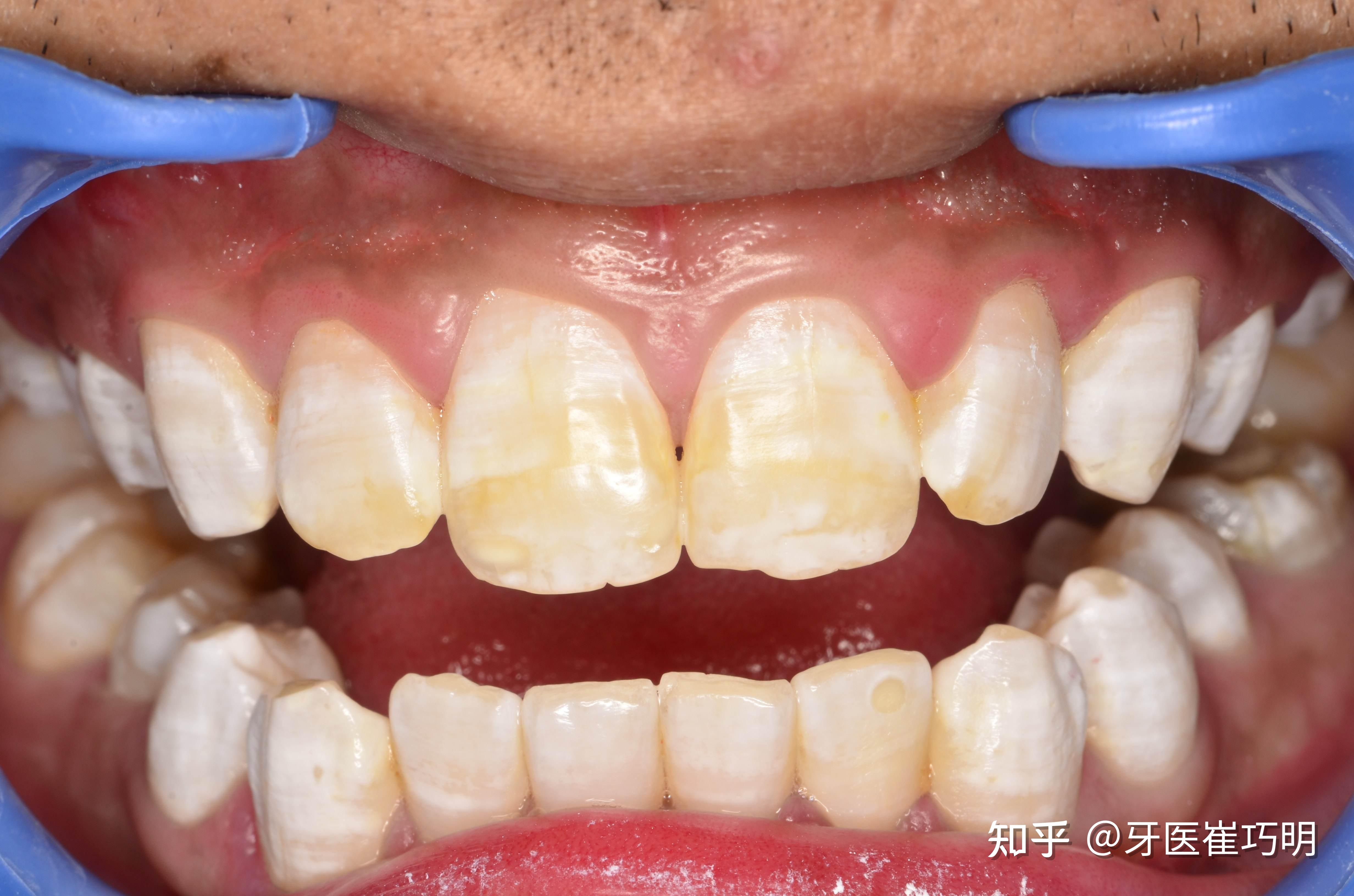 我咬起來會酸痛，無法用力咬-----利用全瓷嵌體修復牙齒斷裂痕 - 案例介紹 - 美容牙科張凱榮醫師