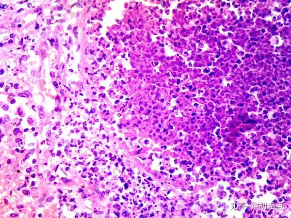 急性肺瘀血慢性肺瘀血蜂窝织性阑尾炎肺脓肿鳞状上皮细胞乳头状瘤电镜