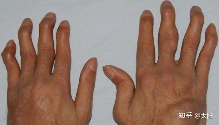 手指出现僵硬就代表着有类风湿性关节炎吗
