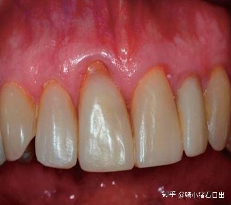 什么样是牙龈萎缩 v2-143fb09cdad8309fe7be92ce52d67a52_r.jpg