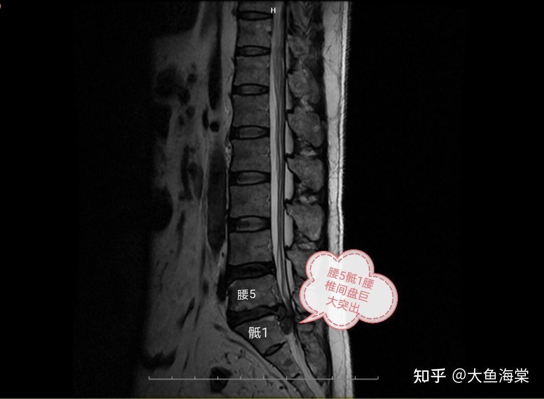 腰椎不同部位的突出分别有哪些症状表现?