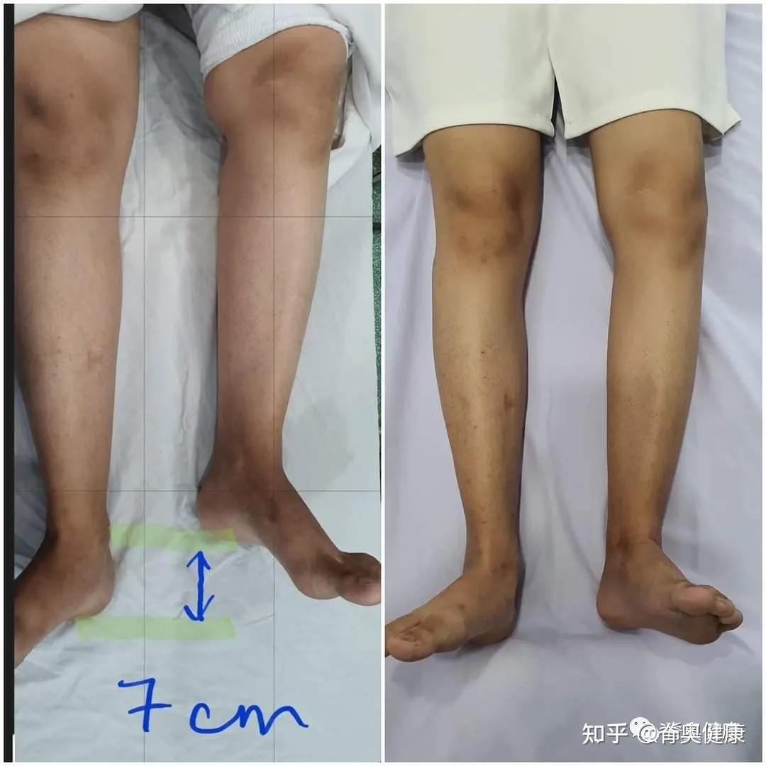 长短腿,可能患者会出现脊柱侧弯的情况;一般是由于患者出现了骨盆的