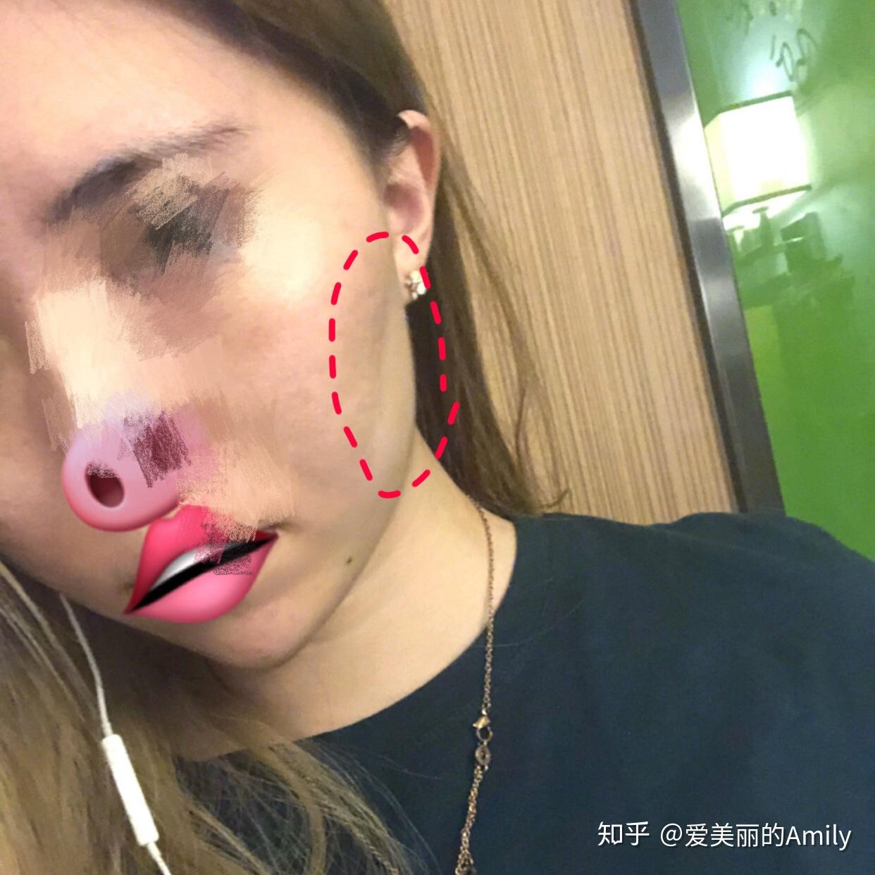 显老10岁有的打完瘦脸针,面颊凹陷呈葫芦脸面具脸其实还只是小意思