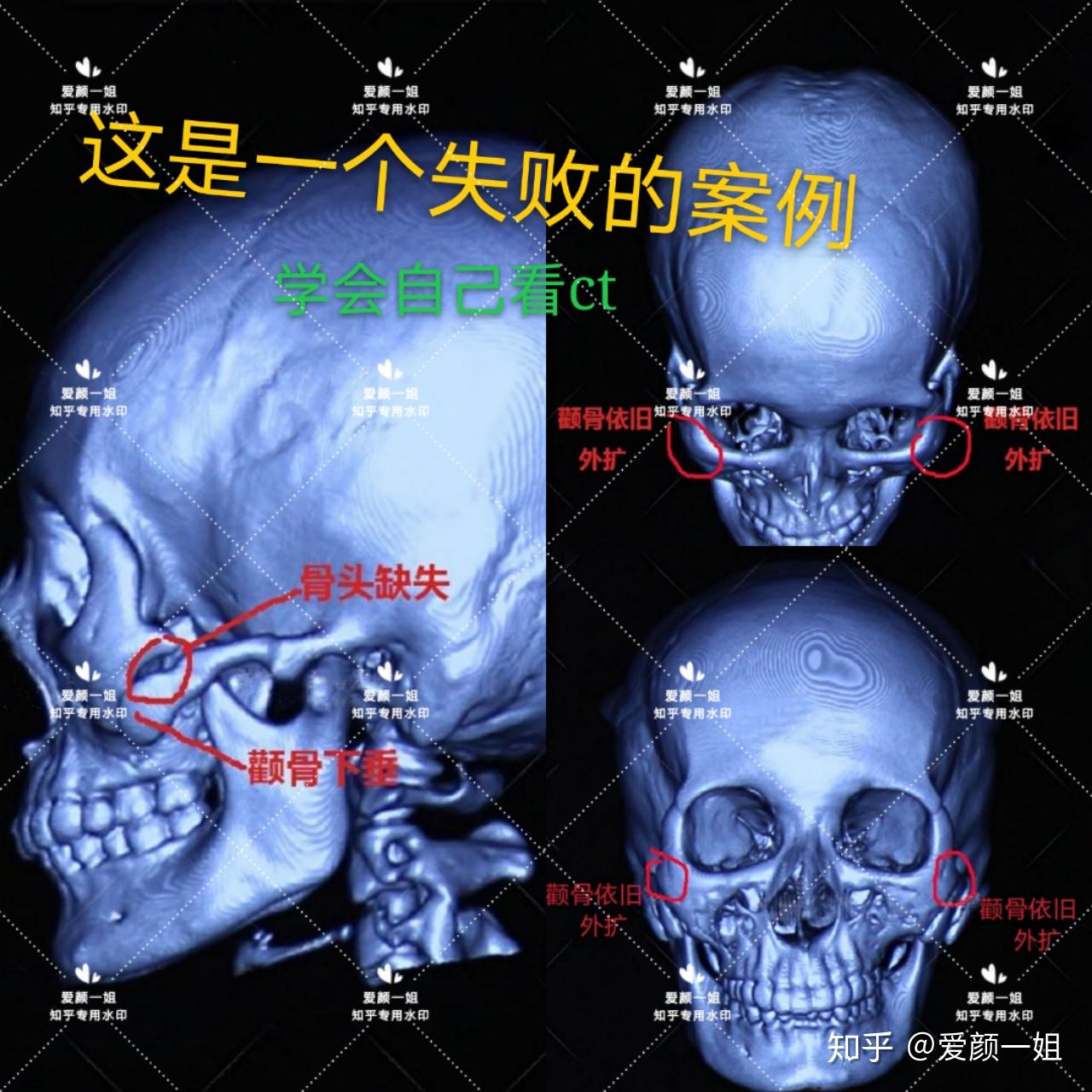 教你看ct【失败】这个准备做颧骨颧弓修复的！常问吉玟锡、杨君毅、郑康在、河东镐、王珍祥、刘祥夏、沈绍勇 - 知乎