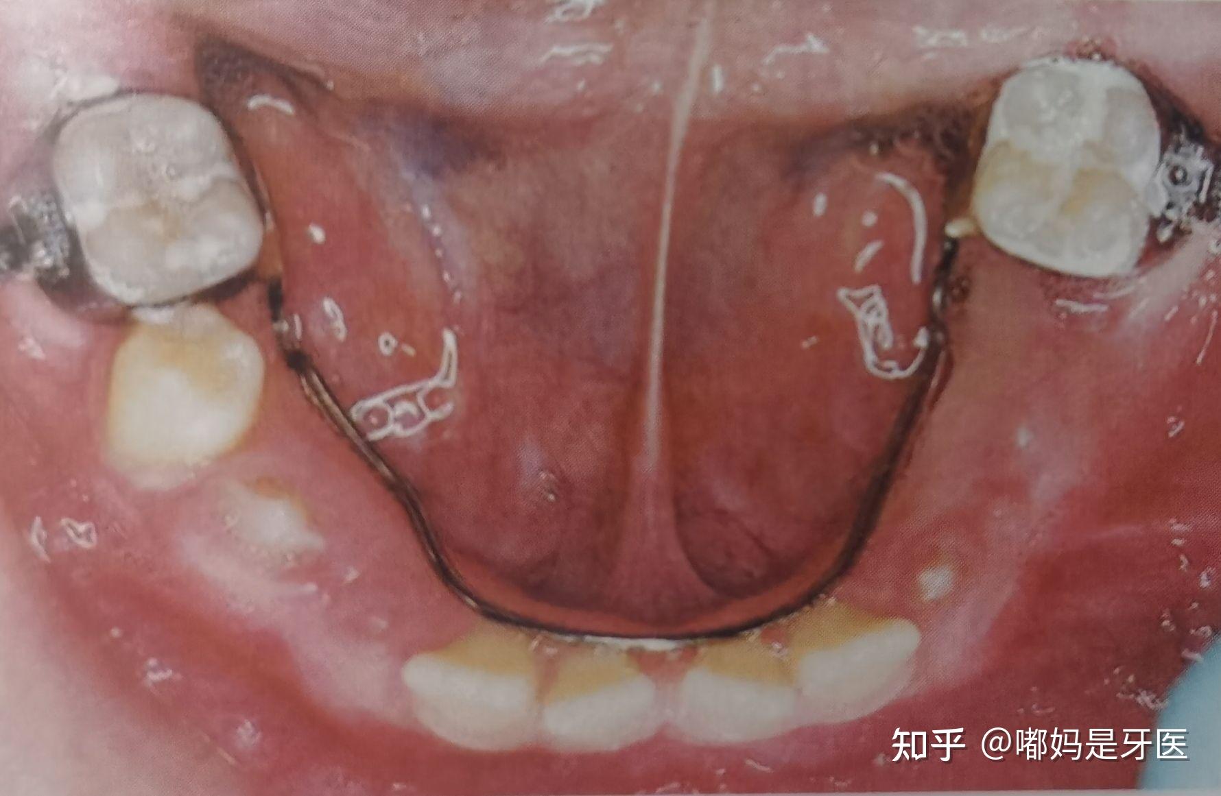 乳牙缺失后最重要的事先检查要不要做缺隙保持器