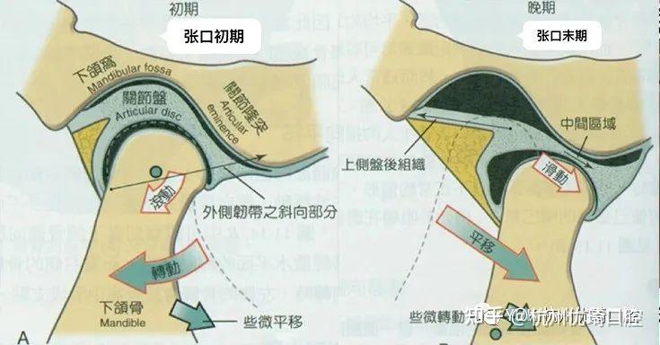 颞下颌关节紊乱不可复不要怕！ - 知乎
