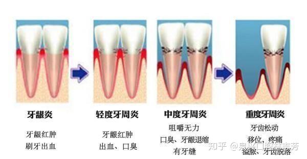 如何區分牙齦炎和牙周炎