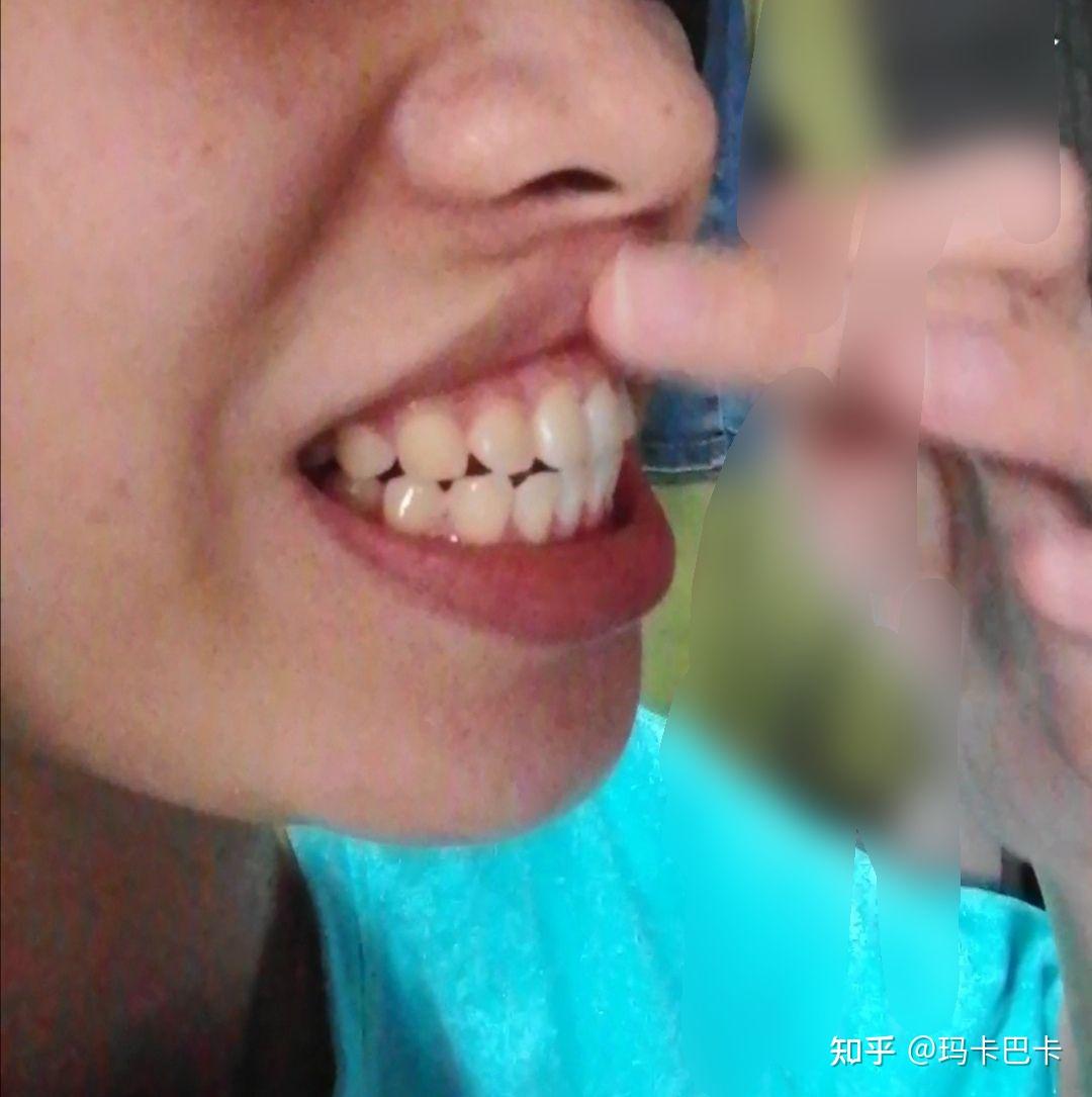 宁芳博士：未拔牙改善嘴凸，变身气质女孩！ （北京牙齿矫正案例） - 哔哩哔哩