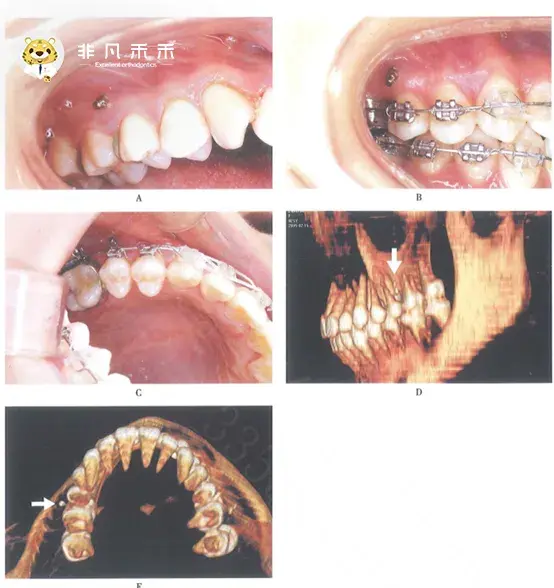 牙齒臨床冠長軸與 平面垂線所組成的角為冠角或軸傾角,代表了牙齒的近