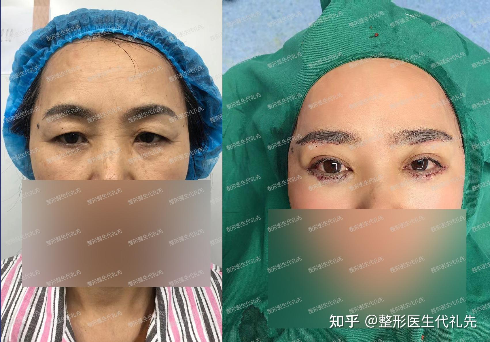 筋膜悬吊提眉手术一个月后的效果，准备做提眉手术的姐妹们来看看术后情况 - 知乎