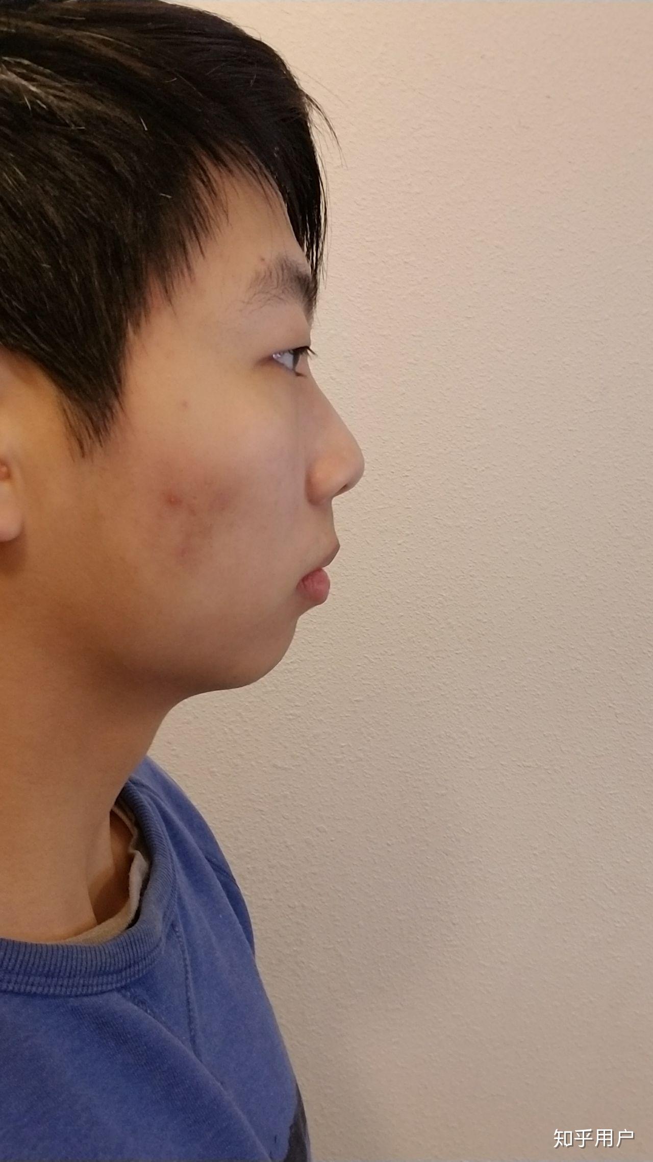 没下巴是怎样的体验