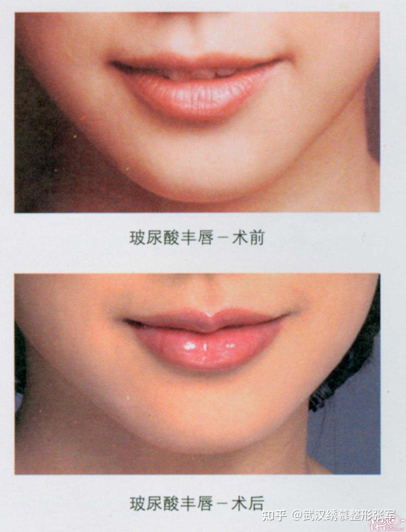 面部年轻的秘密——丰唇术 - 知乎