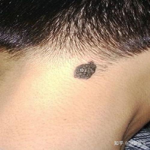 身上这7种痣可能会癌变要注意了