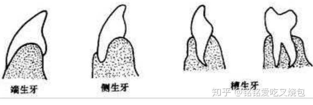 端生牙 侧生牙 槽生牙牙齿按着附着方式分为三种:公元前14世纪《内经
