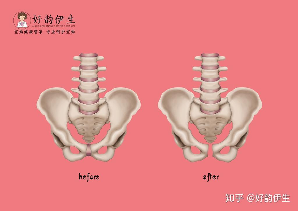 產後恥骨聯合分離怎麼辦