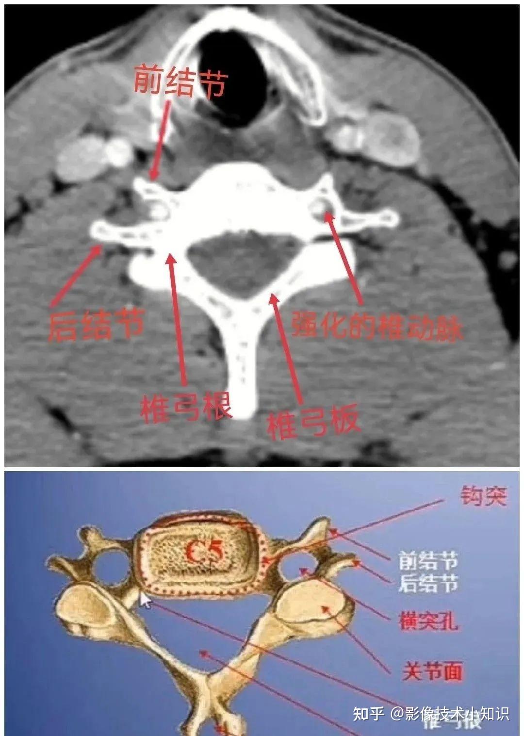 脊柱ct解剖