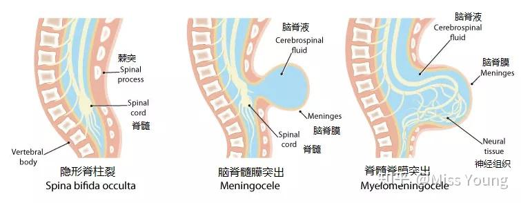 此外,患者的脊髓,神經也受損,表現為下肢麻木,無力,大小便障礙等症狀.