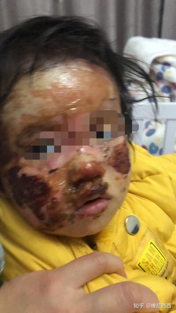 小孩脸部烧伤照片图片