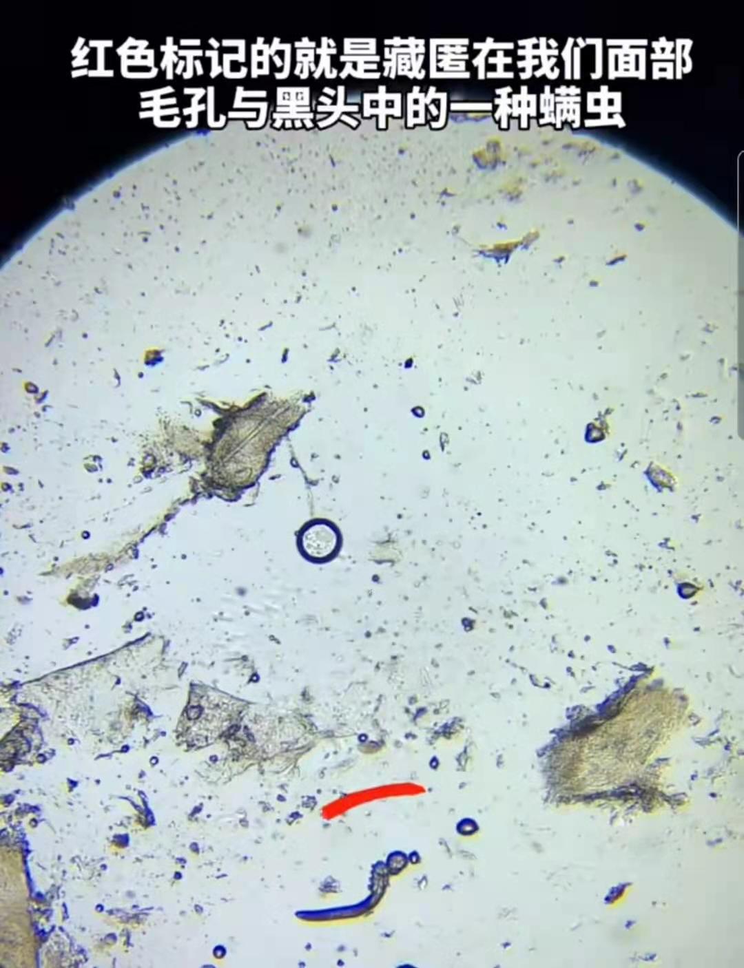 痘痘里面的毛囊虫是怎么被检测出来的