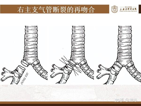 气管外伤、气管断裂——气管支气管裂伤是什么? 如何治疗? - 知乎