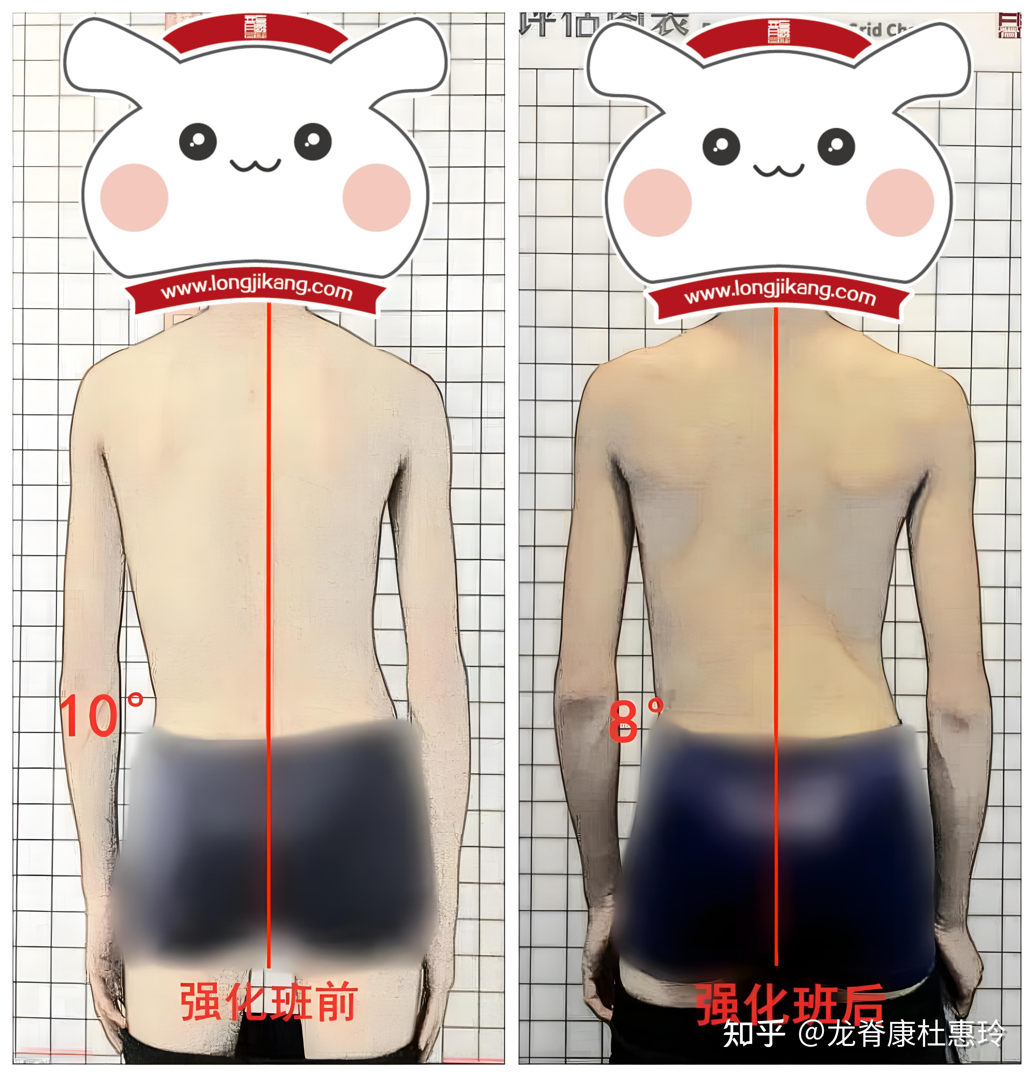 脊柱侧弯参加3天强化班后,剃刀背减少2°,中线基本回直! - 知乎