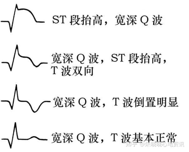 心电图机从体表记录心脏每一心动周期所产生的电活动变化图形的技术