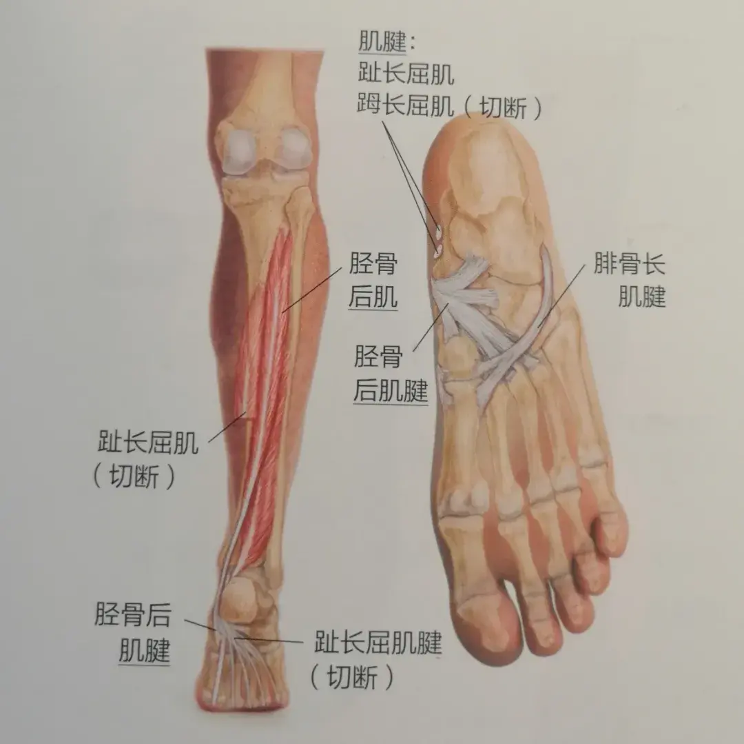 足弓塌陷踝内侧痛站不稳胫骨后肌该如何训练