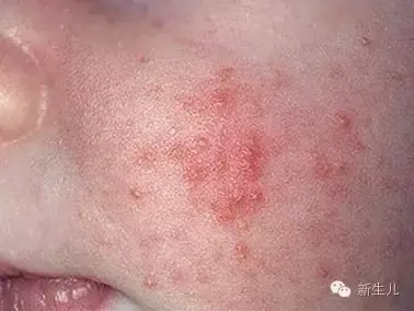 新生儿婴儿皮肤起红疹教你如何护理宝宝娇嫩的皮肤