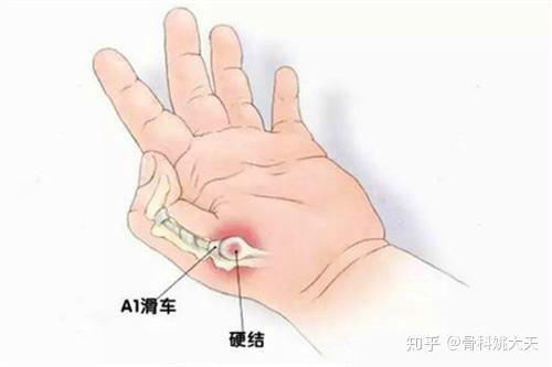 得了腱鞘炎不要怕,只要记住这四点,摆脱烦恼无压力!