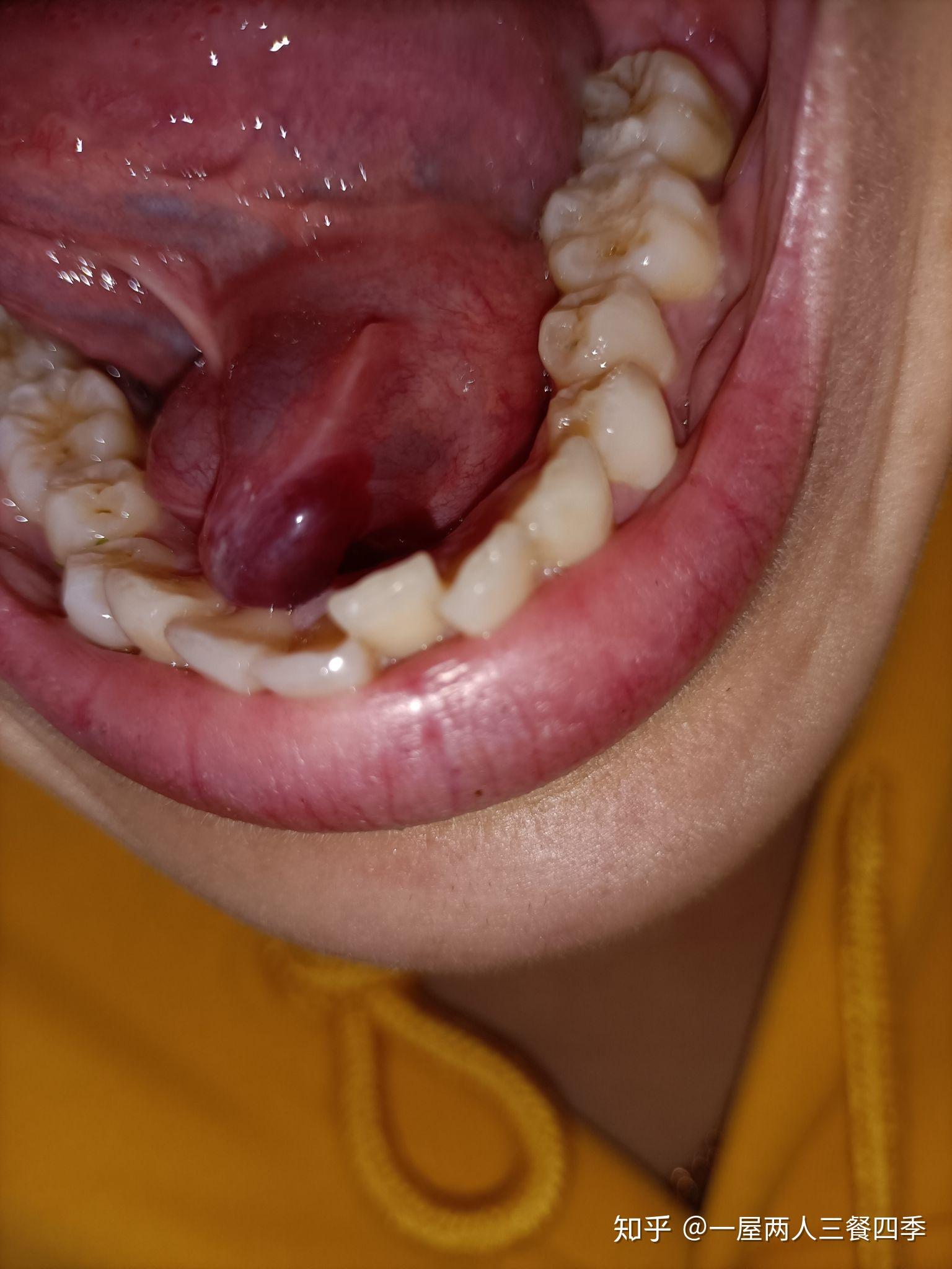 舌下腺开口图片