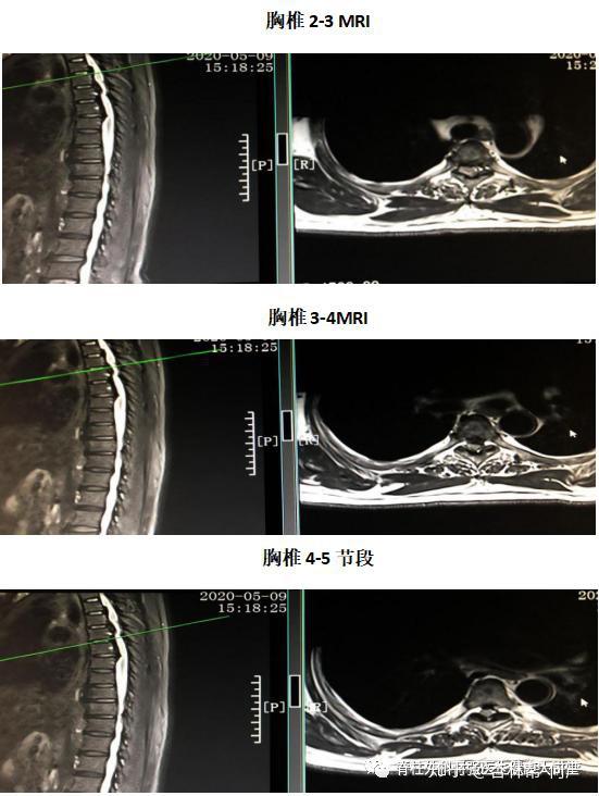 黄韧带mri图片