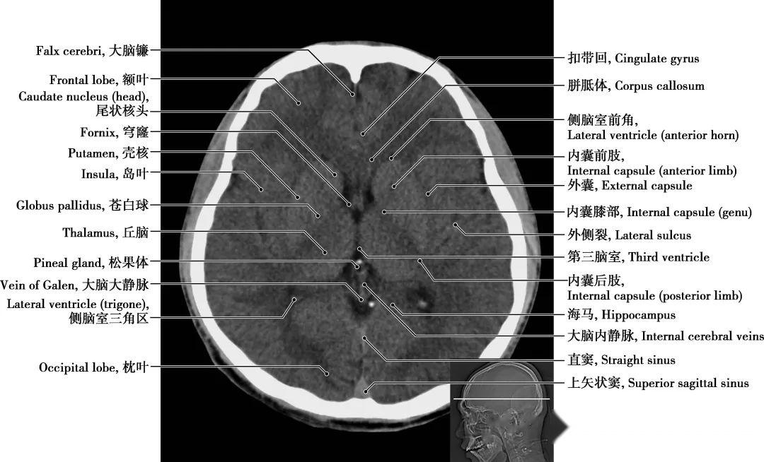 详细标注版!颅脑CT正常解剖图谱 - 知乎