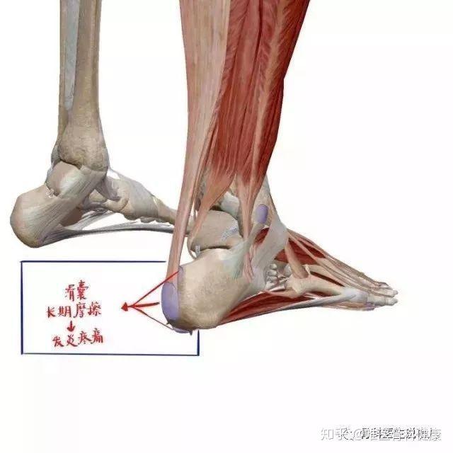 走路脚跟痛?当心"跟痛症"
