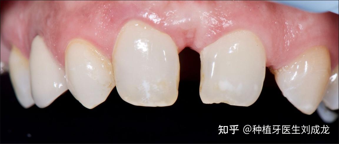 42 岁的女性患者前来医院种植科就诊,她先天缺少 22 号上颌侧切牙(图